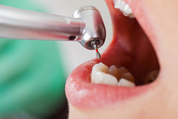 Emergency Dentist for Dental Implants